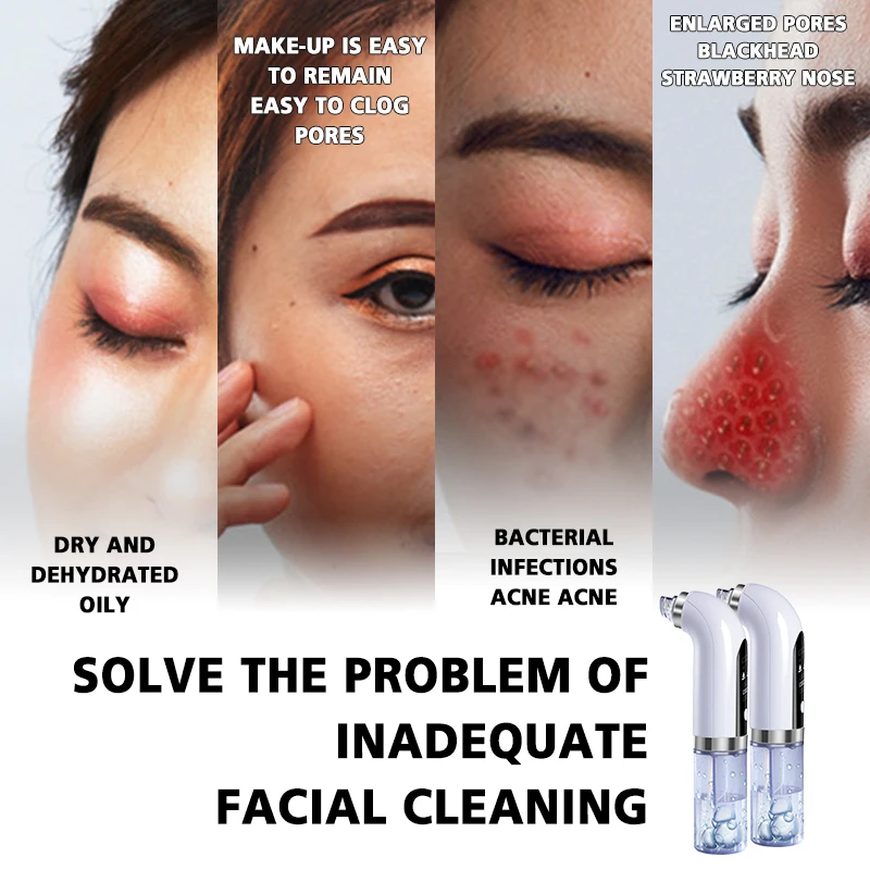 

Blackheads Remover Deep Cleansing of Skin Acne Removal No traces No Damage Vacuum Removal of Blackheads Skin Care Device