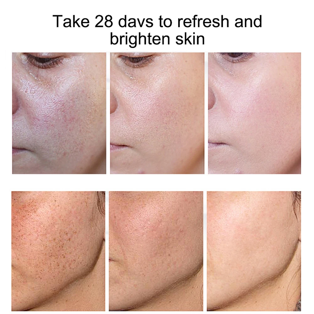 Для удаления темных пятен выцветающий крем для веснушек защита от отбеливания