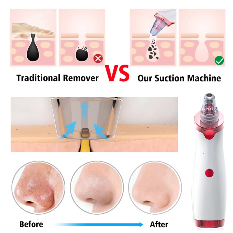 Инструмент для удаления чёрных точек Красота уход за кожей лица Электрический