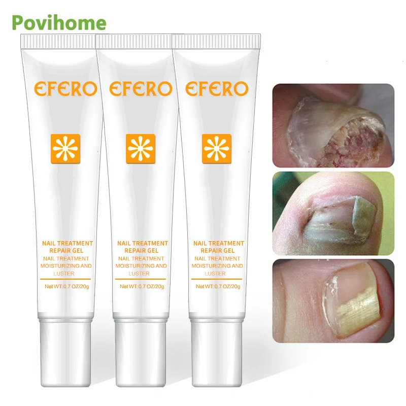 

1Pcs 20g Nail Repair Treatment Essence Whitening Toe Nail Fungus Removal Gel Anti Infection Onychomycosis Cream