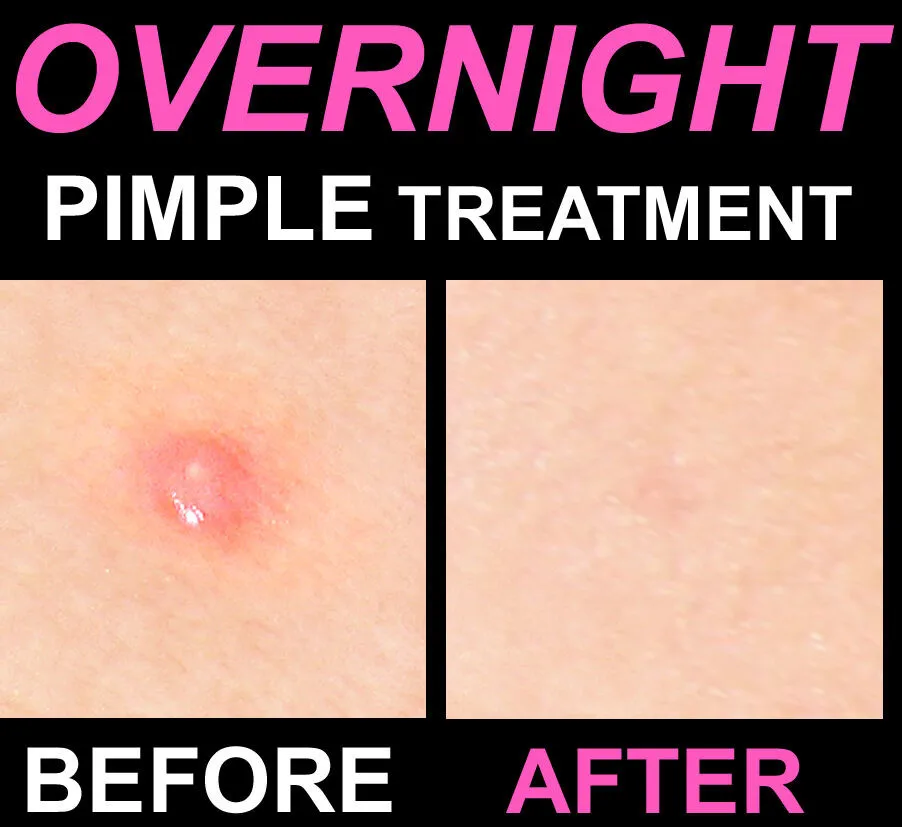 

HERBAL OVERNIGHT SPOT TREATMENT for BLEMISHES PIMPLES ACNE CYSTS and BOILS