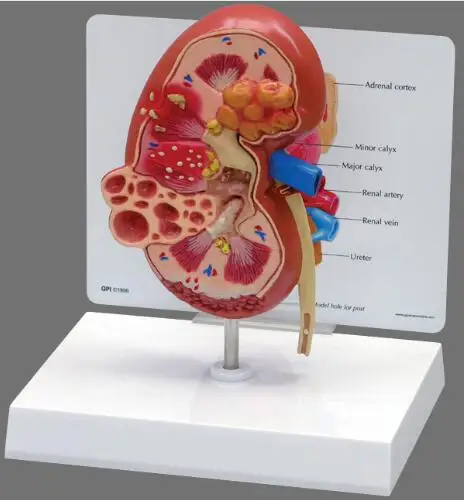 Почечные камни модель заболеваний урология Nephron Renal glomelus анатомическая почечная