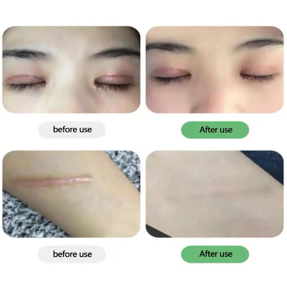 

20g Scar Removal Cream Face Cream For Face Acne Scar Spots Cream Face Remover Stretch Skin Cream Marks Care Skin Repair Acn O9X1