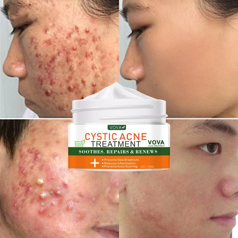 

Effective Acne Face Cream Treatment Cystic Acne Refreshing Oil Control Shrink Pores Whitening Moisturizing Anti-Acne Skin Care