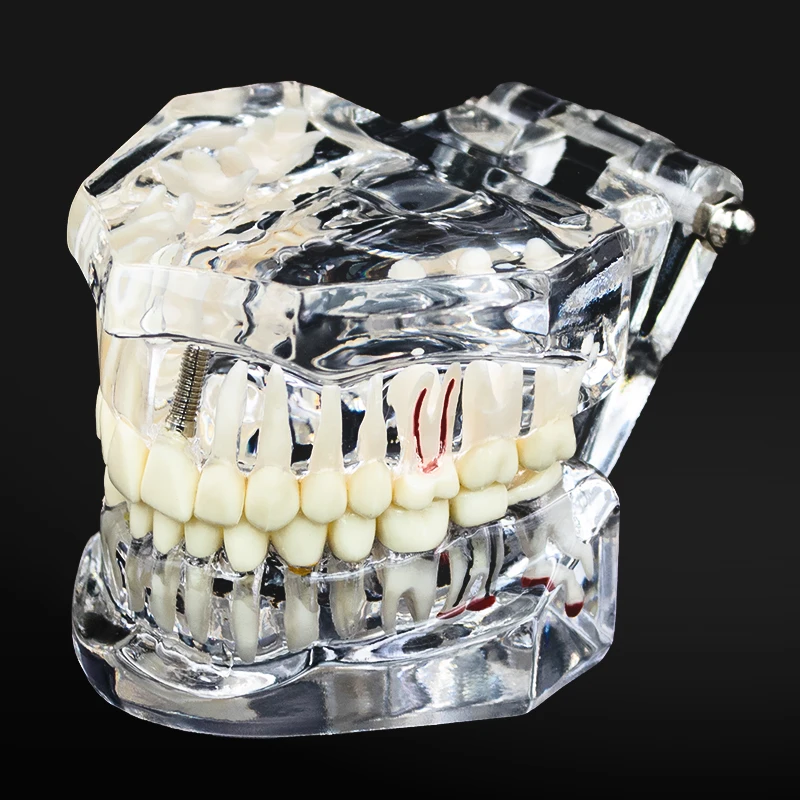 

1 Pcs Dental Model Teeth Implant Restoration Bridge Teaching Study Tooth Medical Science Disease Dentist Dentistry Products