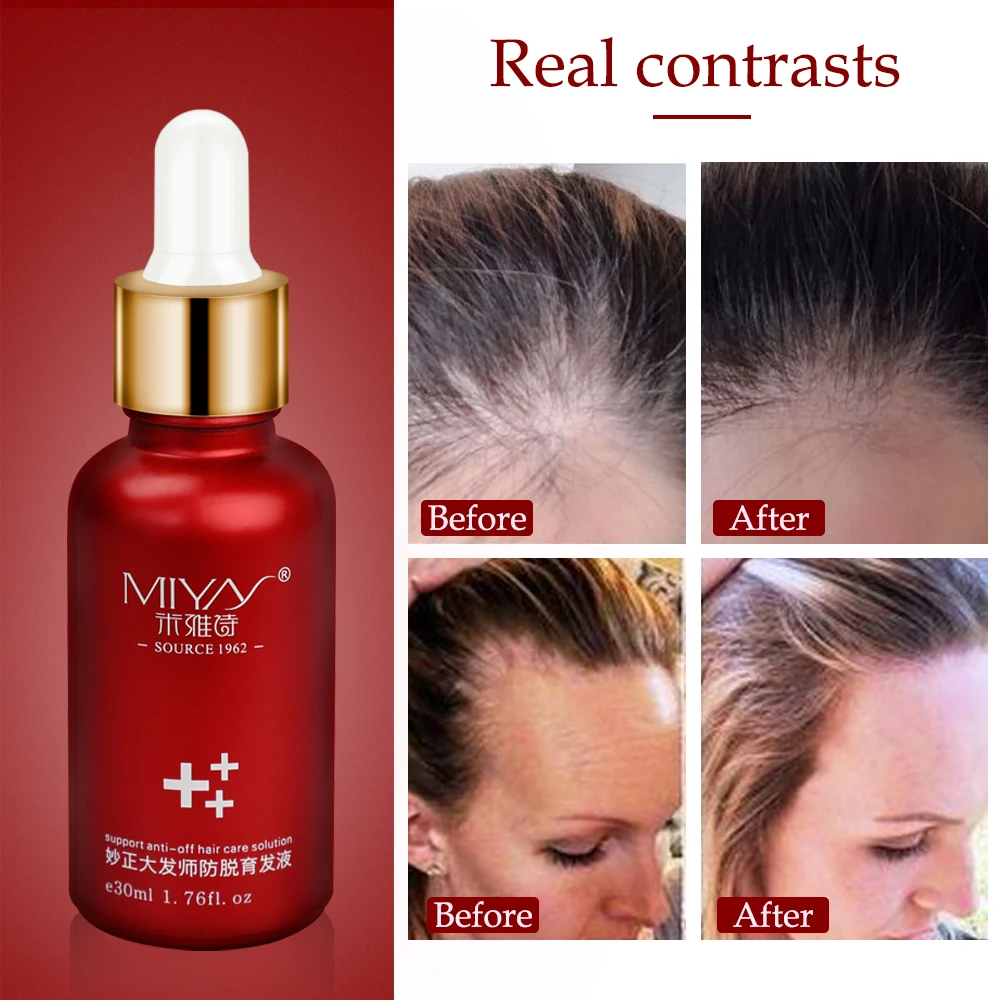 Hair Growth Essence Oil Anti Hair Loss Products for Hair Growth Treatment Genger Natural Serum Hair Thickener Care Solutions