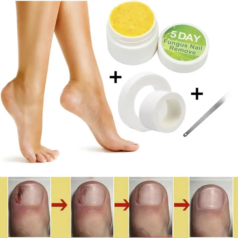 5 DAYS Toenail Nail Fungus Remover Kit Bandage File Repair Onychomycos Nourishing Chinese Nails Care Tool TSLM2 |