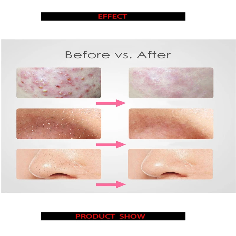 Устройство для удаления черных точек приспособление набор инструментов и