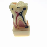 dentist dental study teach tooth model teeth disease model new dental supplies