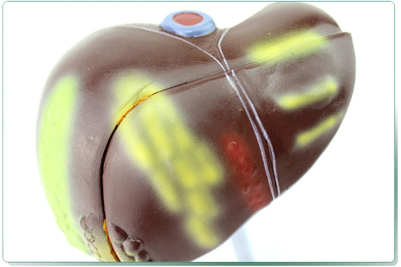 Гепатит В жировая печень цирроз печени модель пищеварительная медицина