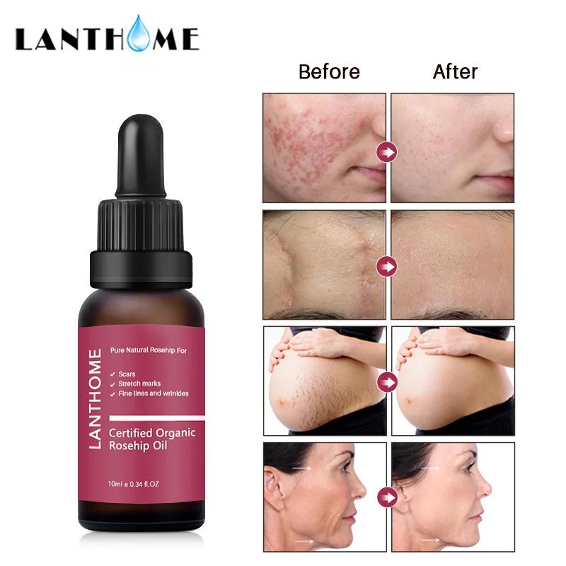 

Rosehip Oil Antioxidantfor Scars Fine Lines Wrinkles Stretch Marks Improve Skin Elasticity Firmness Facial care Essential oil