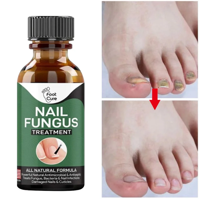 Быстрое лечение ногтей от грибка восстановление эссенции сыворотка уход за