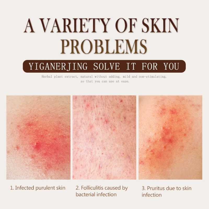 

YIGANERJING Skin Psoriasis Cream Dermatitis Eczematoid Eczema Ointment Skin Care Cream for Skin Pruritus Problem Cream Body Care