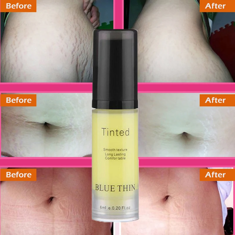 

Pragmatic Stretch Marks Repair Cream Removal Scar Marks Cream Fat Scar Striae Efficient mild Treatment Maternity Skin Health