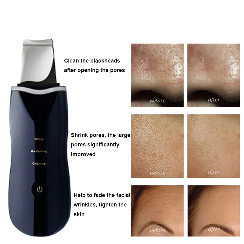 Ультразвуковой ионный скребок для глубокой очистки кожи очиститель пор пилинг