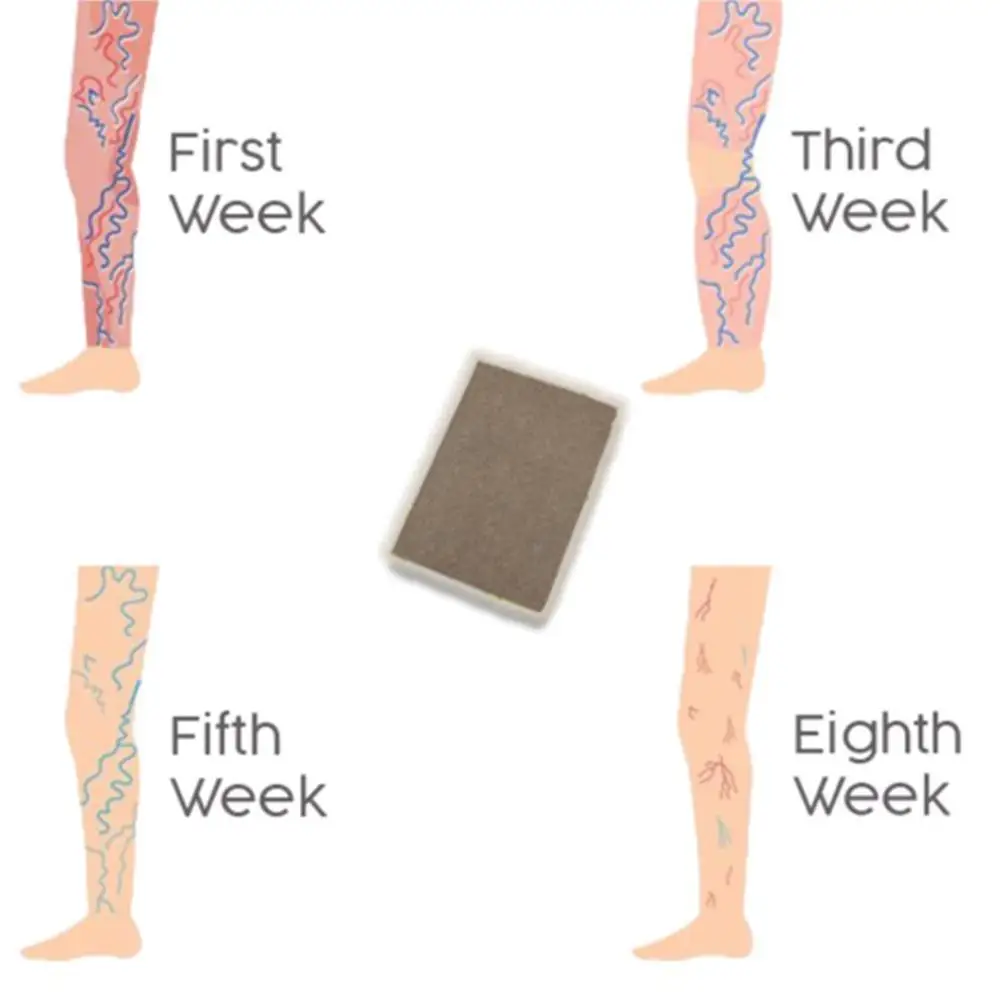 3 шт. сосудистых звездочек варикозное расширение обработка штукатурка вен