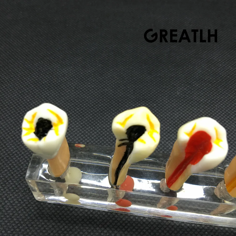 Стоматологическая 5 ступенчатая модель для эндодотического лечения корневых