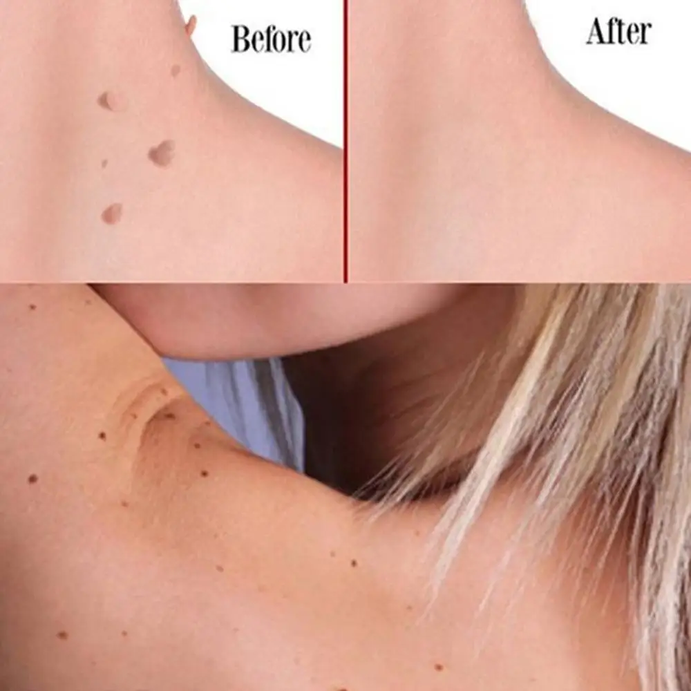 Крем для лечения бородавок устройство удаление Антибактериальная мазь удаления