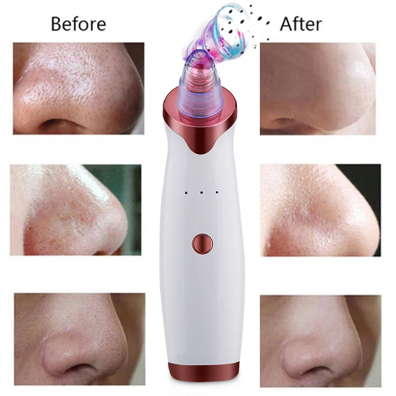 

Electric Blackhead Vacuum Extractor Tool Acne Remover Point Noir Black Spots Pore Cleaner Skin Care Facial Pore Cleaner Machine