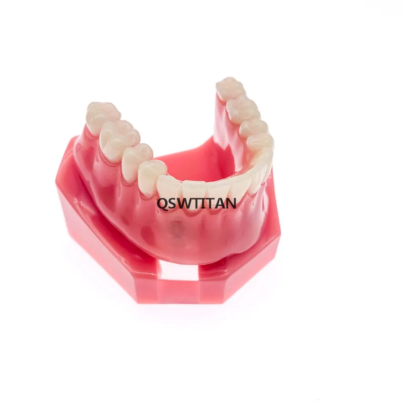 Стоматологическая уступает имплантат Overdenture 6007 модель зубов 2 импланты с