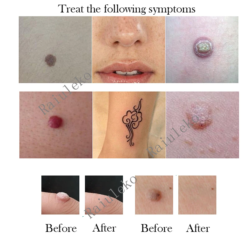 

Dedicated Needles Mole Removal Pen Needle For Laser Tattoo Freckle Spot Mole Removal Pen Accessories