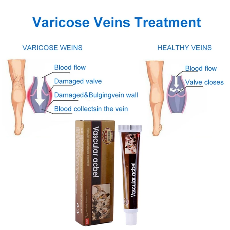 Крем против варикозного расширения вен облегчение флебита ангиит кровеносный