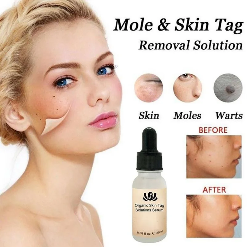 Organic Tags Solutions Serum Mole & Skin Tag Removal Solution Painless Dark Spot Removal Freckle Removal Cream Oil Plaster