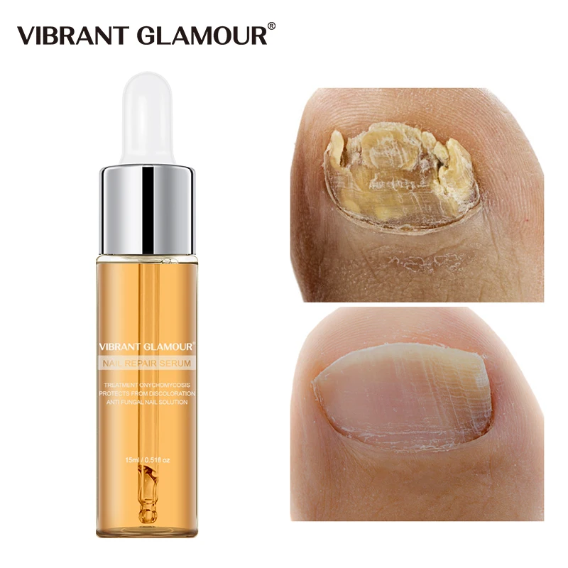 Сыворотка для ухода за ногтями ногтей лечение онихомикоза 15 мл грибок | Красота и