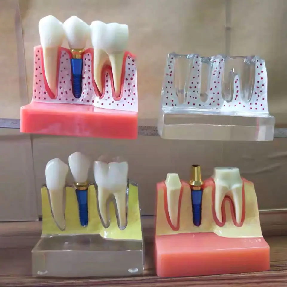 1 шт. 4 кратная модель имплантатов зубов орального обучения стоматологической