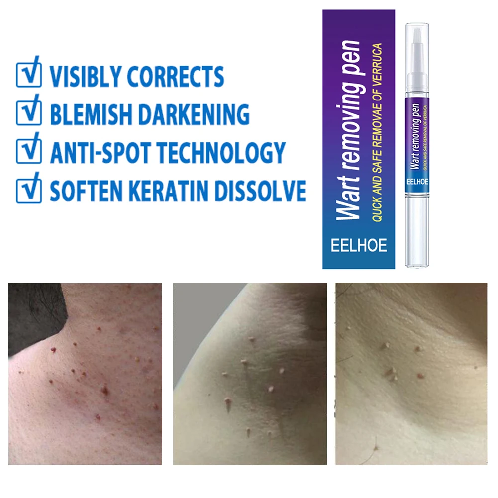 Крем для удаления папилломы родинок безболезненных пятен на лице веснушек