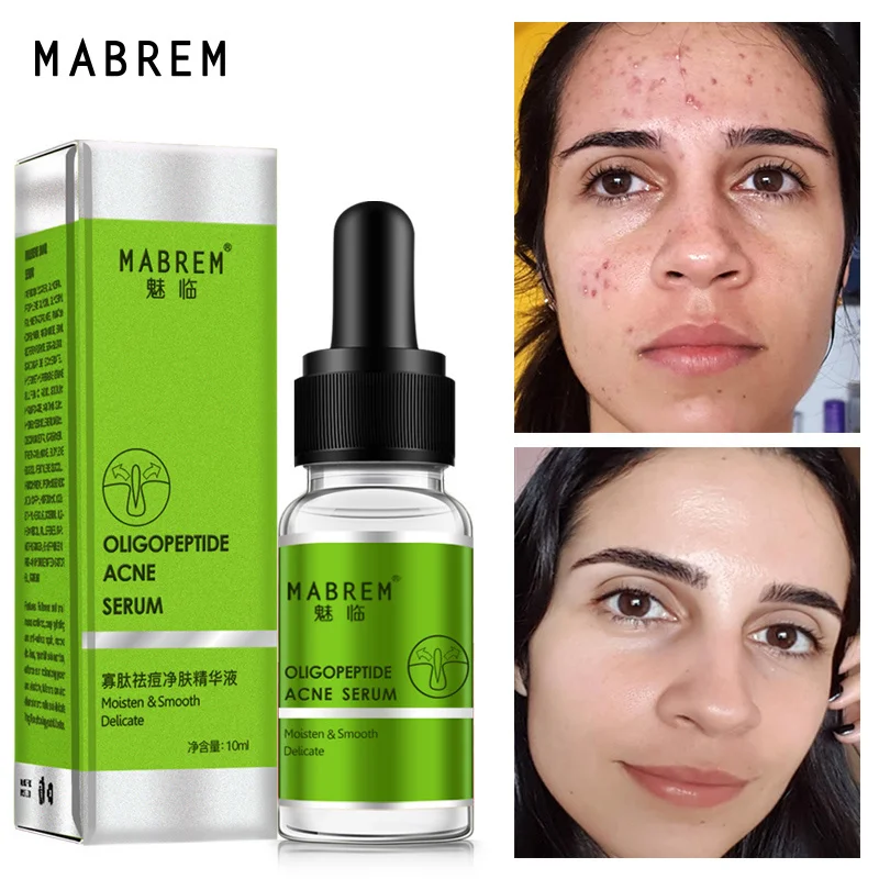 

MABREM Acne Treatment Serum Skin Care Oligopeptide Acne Essence Cleaning Pore Repair Remove Acne Scar Whitening Brighten Lotion