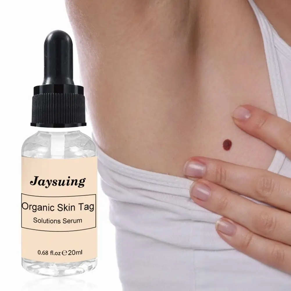 

20ml Mole And Skin Tag Remover Liquid Genital Wart Treatment Papillomas Removal Of Warts Skin Tags Removing Against Moles
