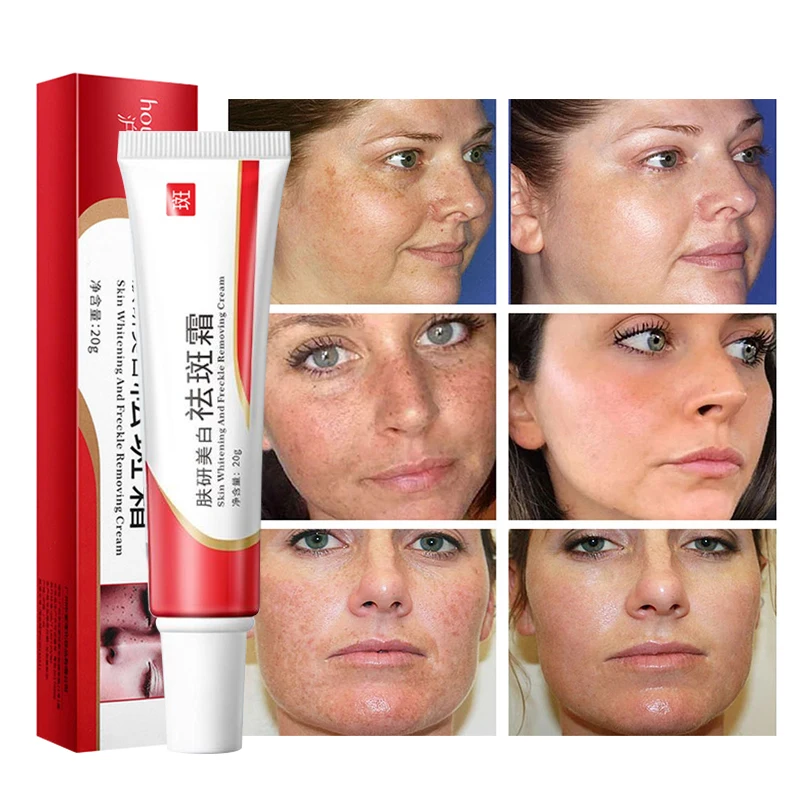 

Effective Whitening Freckle Cream Remove Melasma Acne Spot Pigment Melanin Dark Spots Pigmentation Moisturizing Gel Skin Care