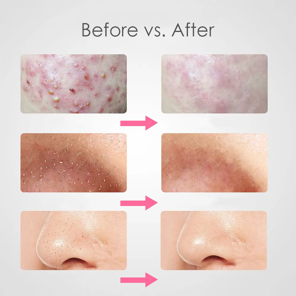 3 шт. игла для удаления угрей прыщей игл нержавеющая сталь экстрактор Поппер