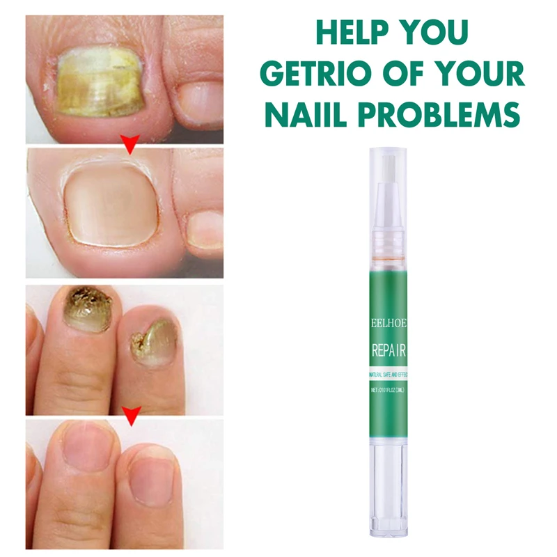

3ml Nail Repair Pen for Nail Onychomycosis Nutrition Pen To Repair Yellow Nails