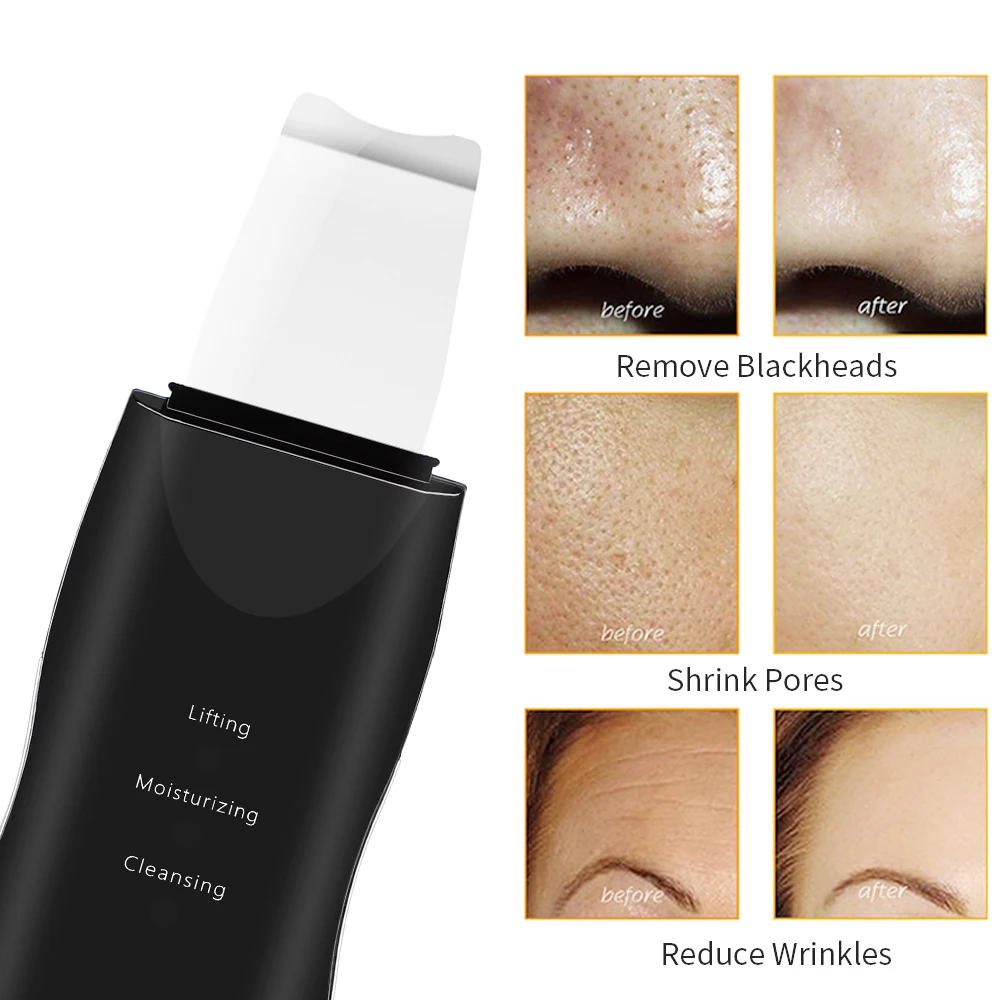 

Ultrasonic Skin Scrubber Deep Face Cleaning Machine Peeling Shovel Facial Pore Cleaner Face Skin Scrubber Face Lifting Tool