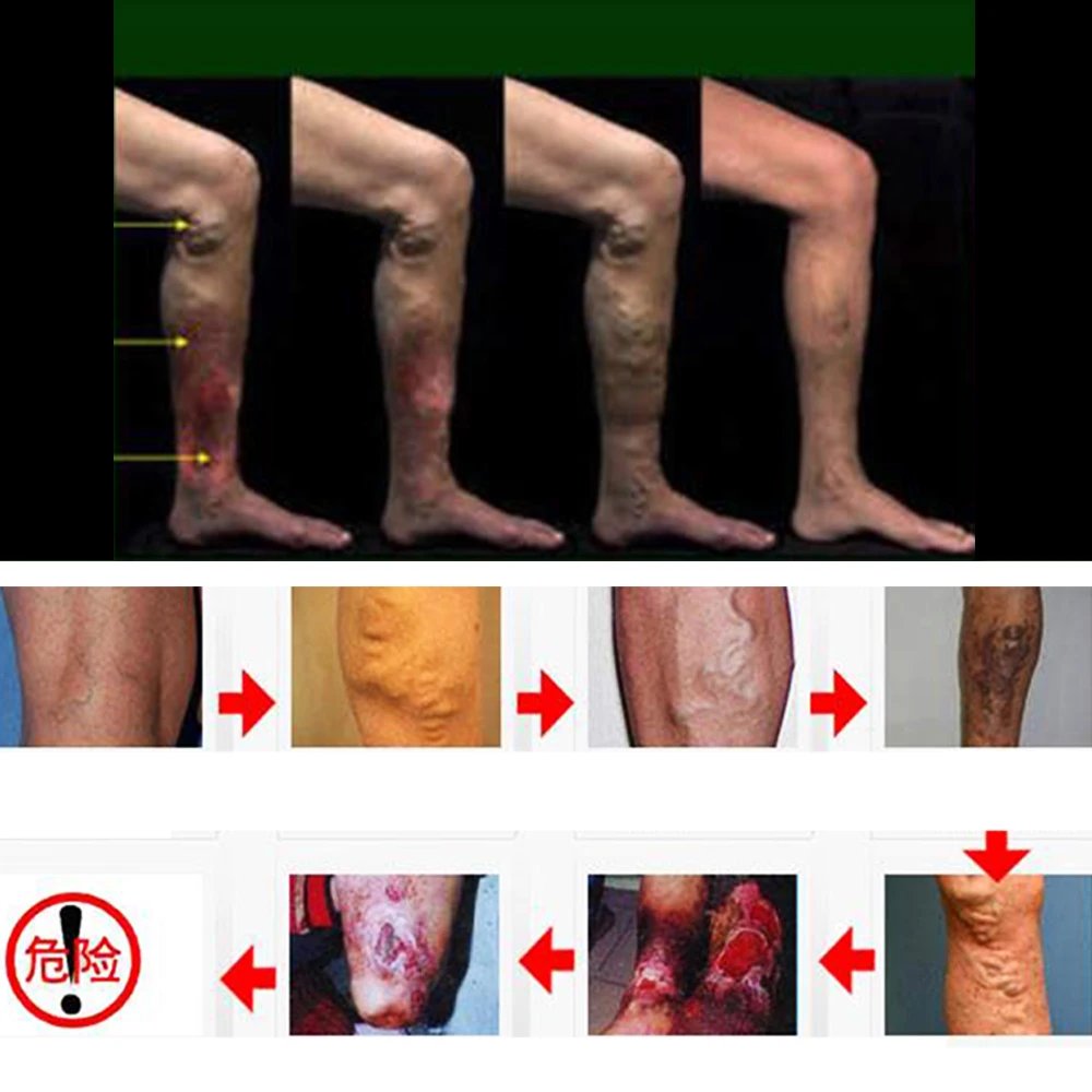 Крем от варикозного расширения ног вен боли в варикозном и паука 100% трав