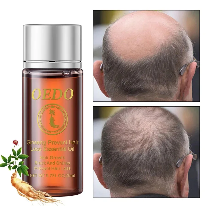 20 мл эфирное масло женьшеня для предотвращения выпадения волос стимулирует рост