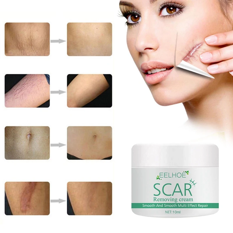 

Smooth Skin Acne Scar Stretch Mark Remover Repair Cream Acne Spot Scar Cream Scar Removal Stretch Mark Removal Cream
