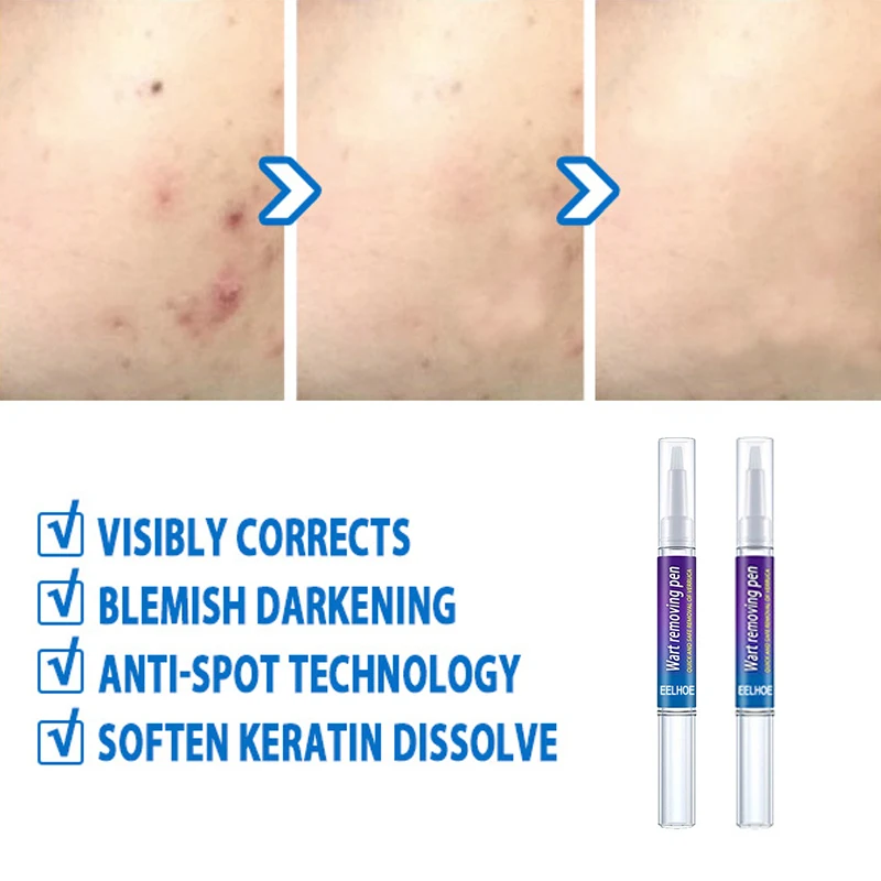 1 шт. жидкая ручка для удаления бородавок на лице | Красота и здоровье