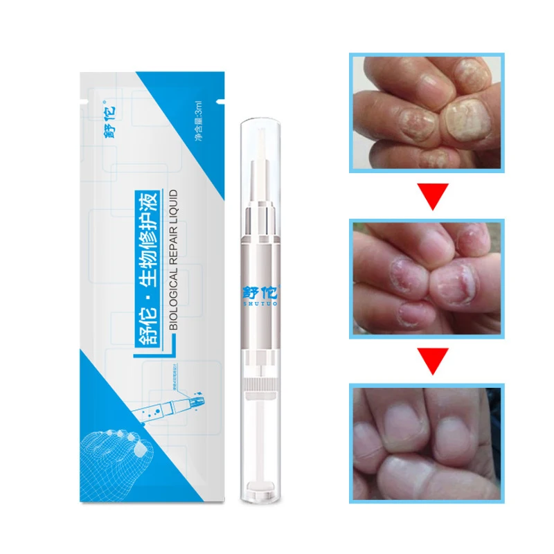 Средство для лечения грибка ногтей 3/5/10 мл средство онихомикоза паронихия