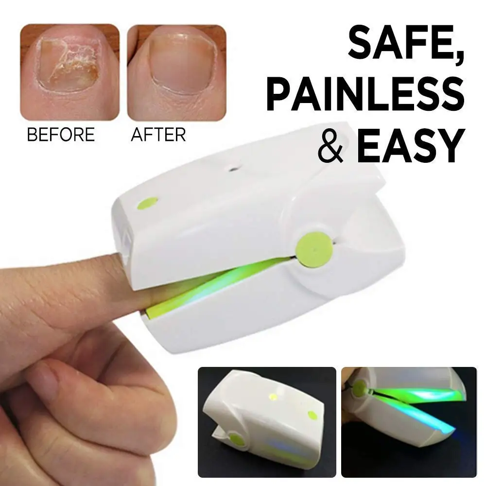 Nail Fungus Onychomycosis Laser Treatment Instrument Anti Fungal Laser Device Low Level Laser LLLT Toenails Home Use No Pain