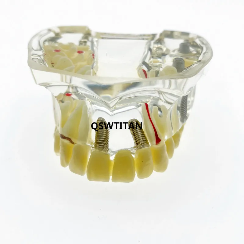 Модель зубного импланта с имплантатом и коррекцией кариес стоматологическое