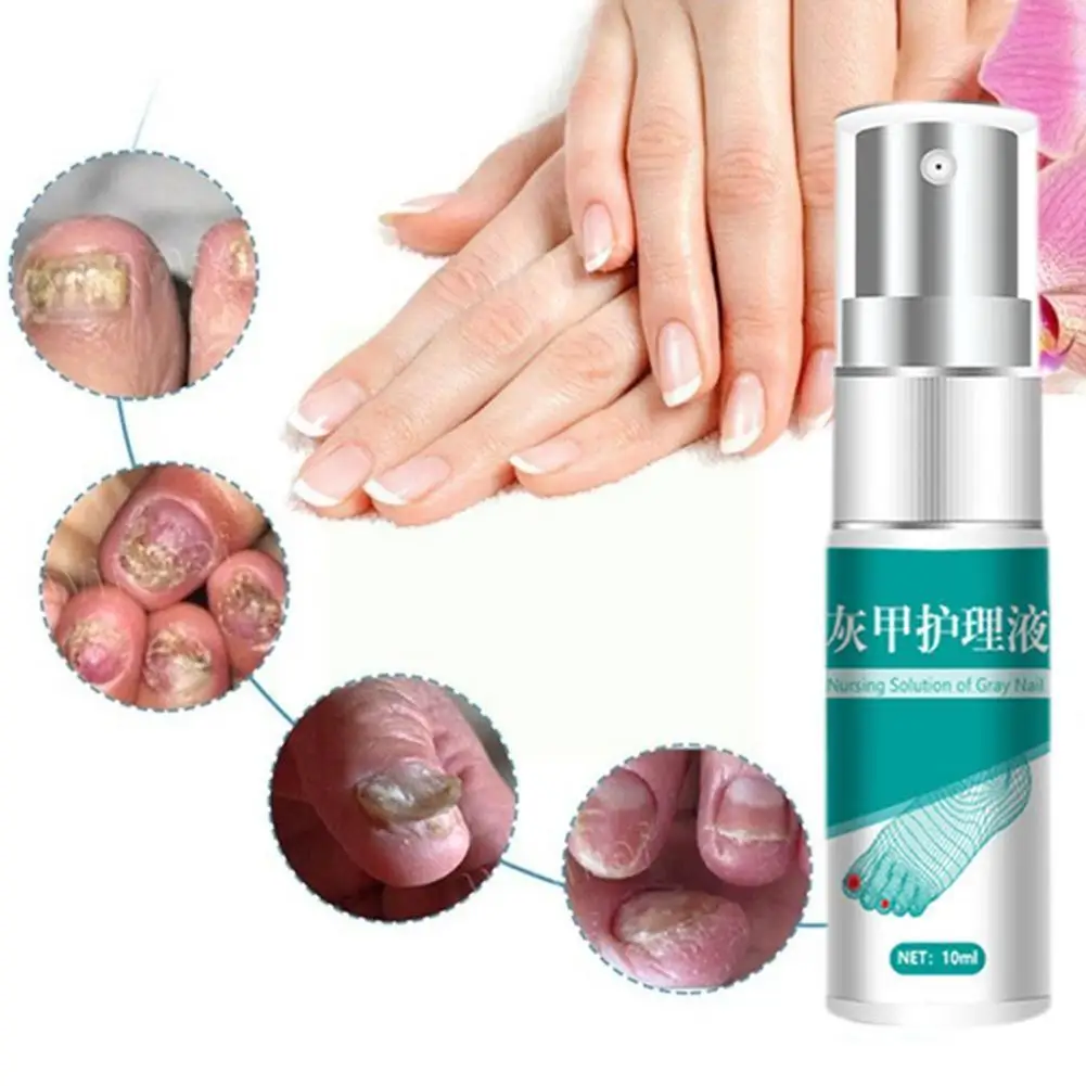 

10 мл, Лечение грибка ногтей, уход за ногами, эссенция для ногтей, ног, гель для грибка ног, онихомикоз, противоинфекционное удаление паронихи...