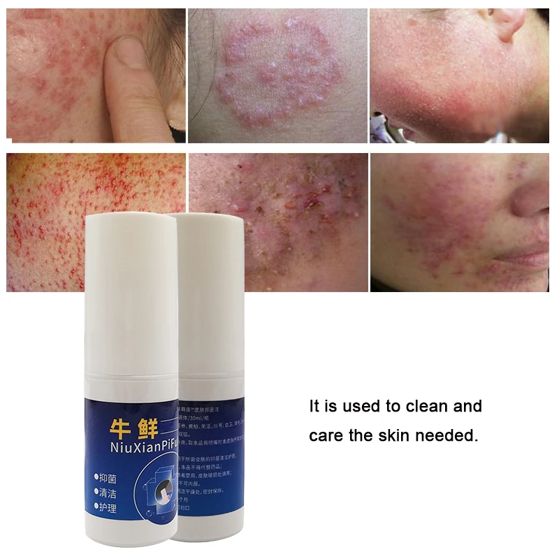 Китайский натуральный спрей Psoriasi Eczma для лечения дерматита псориаз экзема