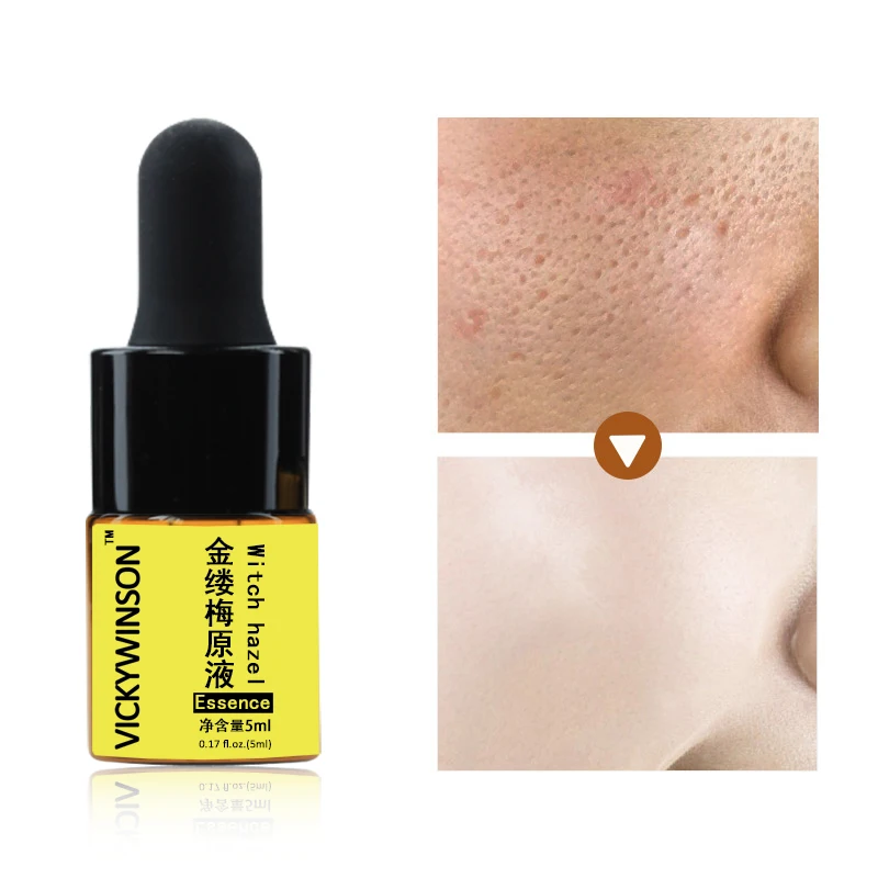 

Эссенция Witch hazel 5 мл, лечение акне, средство для удаления черных точек, крем против акне, контроль жирности, сокращения пор, быстрое уход за ли...