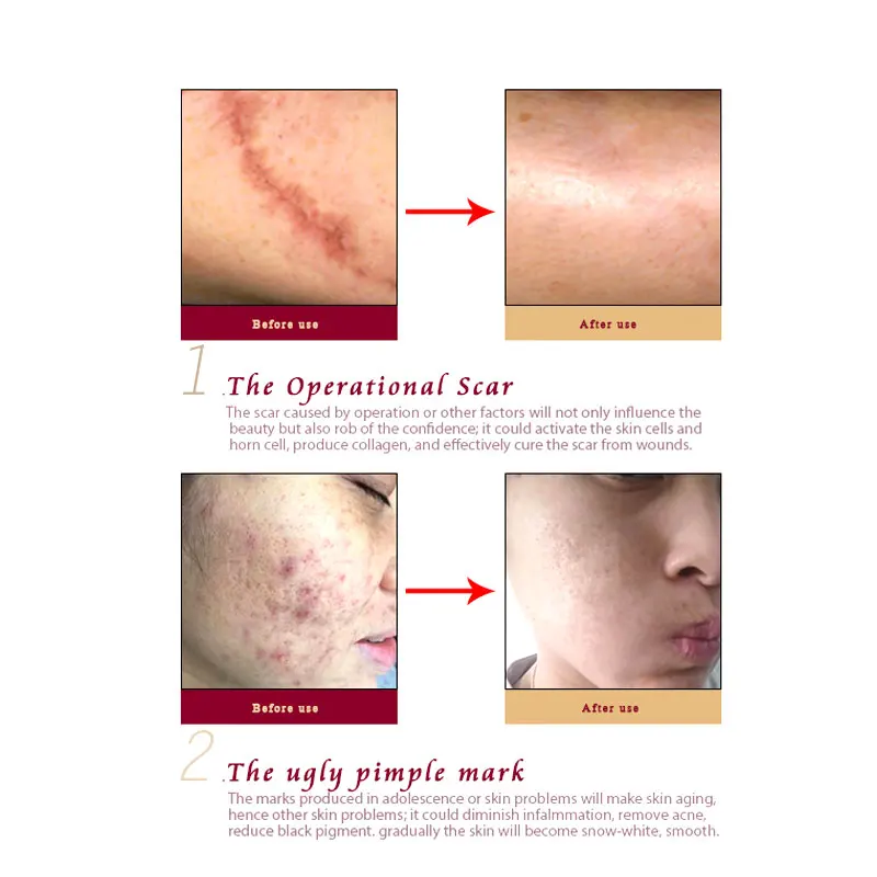 Крем для удаления шрамов от акне ARTISCARE 30 мл крем восстановления кожи лица пятна