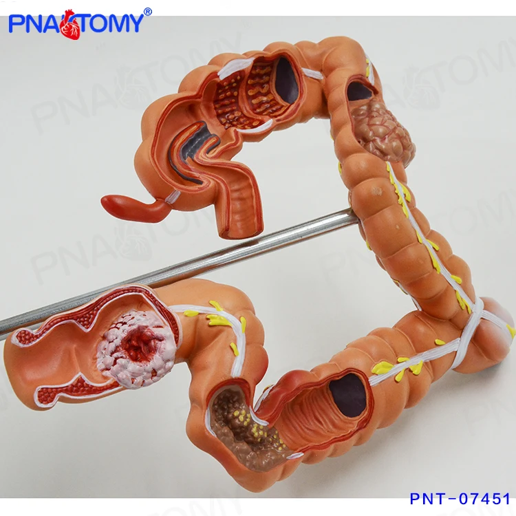 

Human Digestive System Organ Anatomy Diseased Large Intestines PNT-07451 Medical Supplies and Equipment Anatomical Model