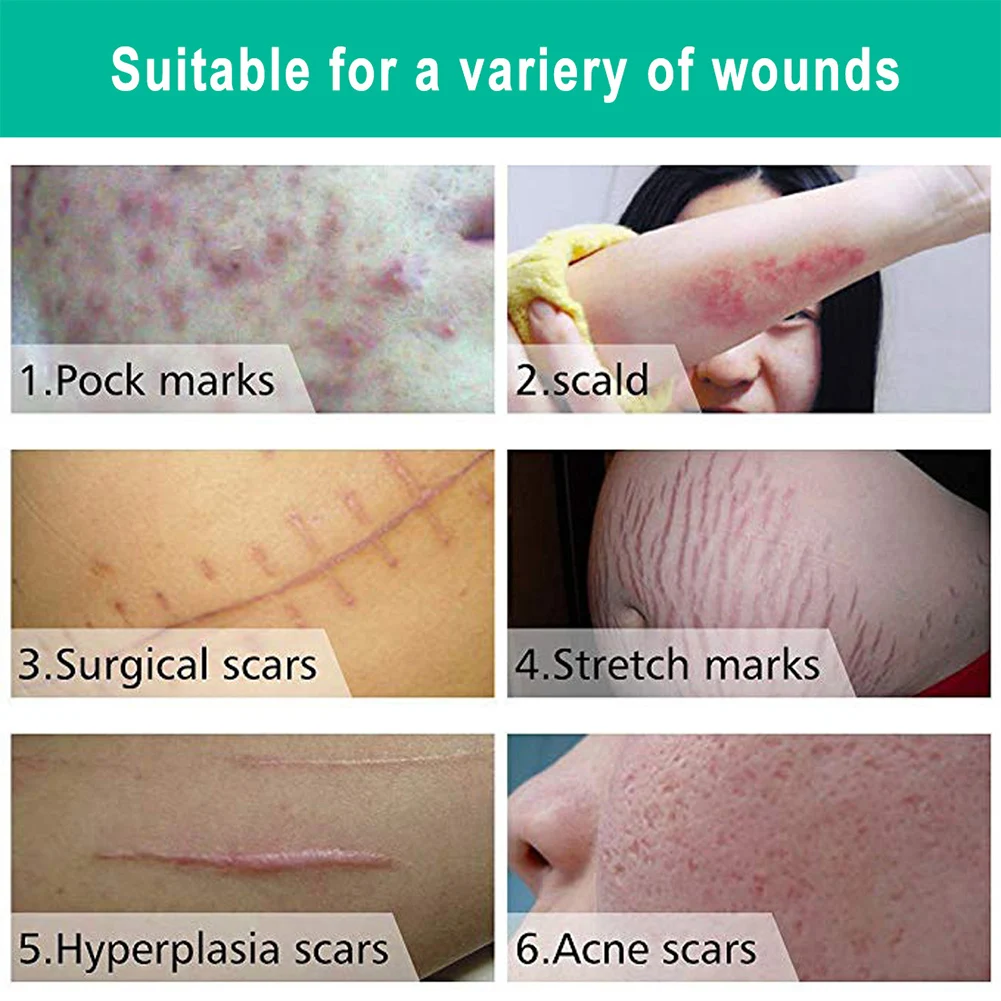 Scar Removal Cream for Acne Marks Burns Stretch Mark Surgical Scars Promote New Skin Growth Treatment Care | Красота и здоровье