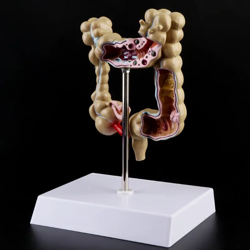 

2021 New Human Colorectal Lesion Model Pathological Anatomy Colon Diseases Intestine Teaching Learning Tool